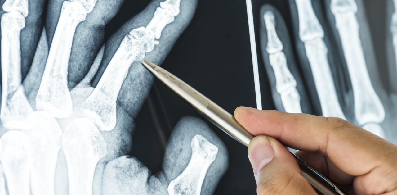 Man pointing at finger joints in hand x-ray
