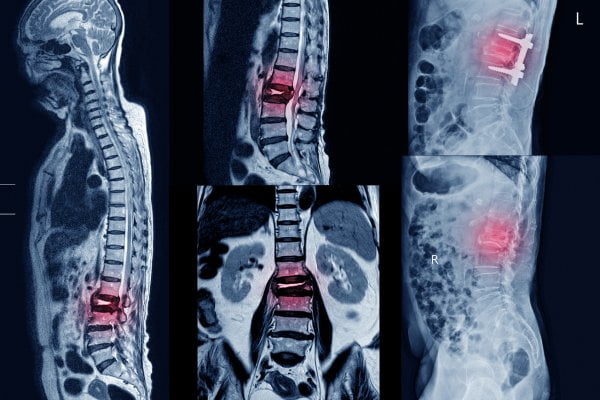 x-ray of a spinal cord
